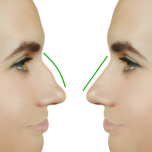 Benang Hidung & Tip Nose - Image 5