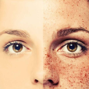 Pigmentation - Image 3