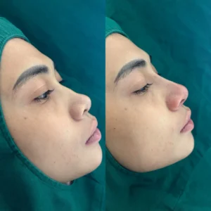 Benang Hidung & Tip Nose - Image 3