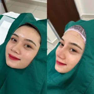 Benang Hidung & Tip Nose - Image 2