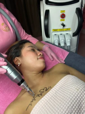 Tattoo Laser (Color Ink)
